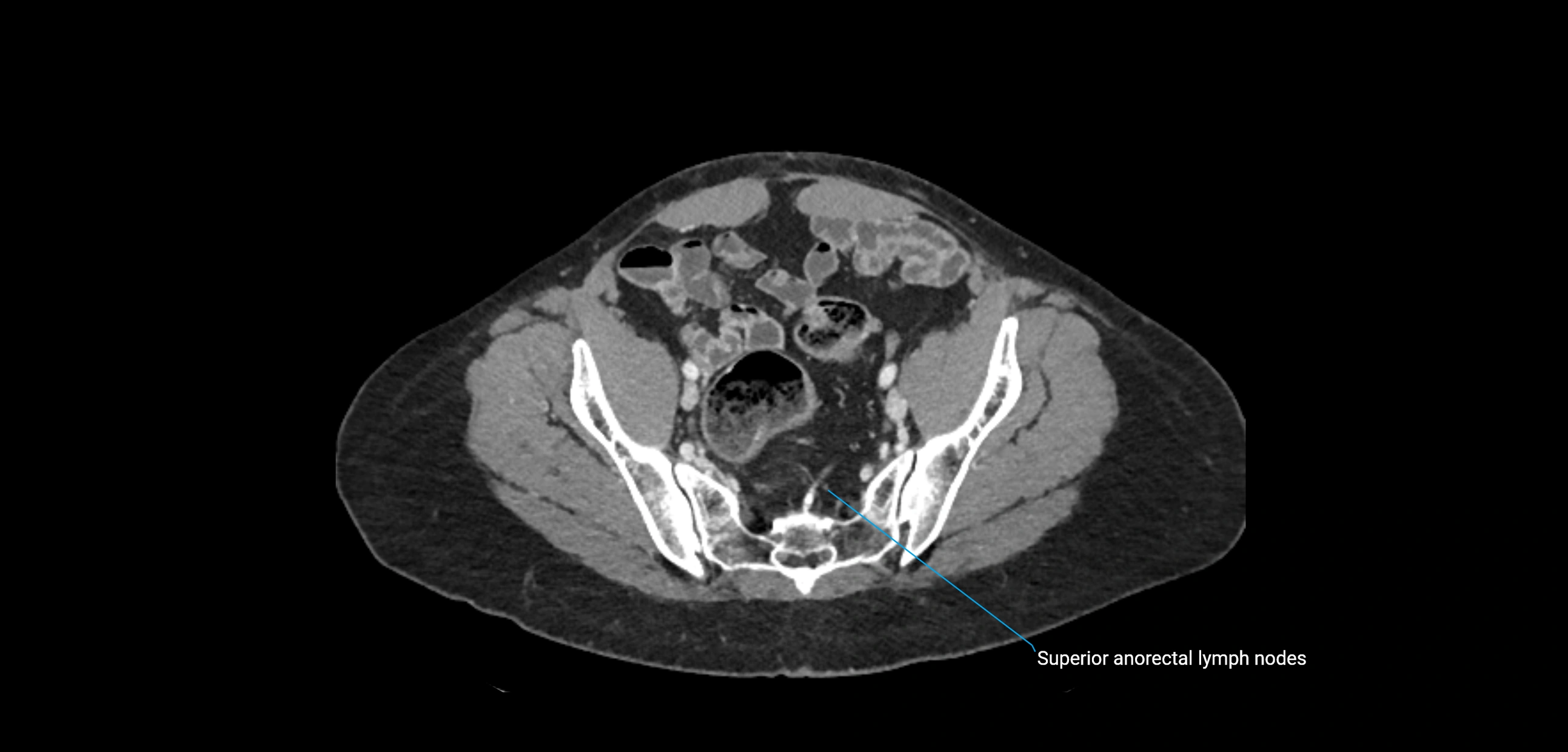CT ct abdominal lymph nodes  axial cross sectional anatomy  enchanced radiology image -img-00002-00339.webp
